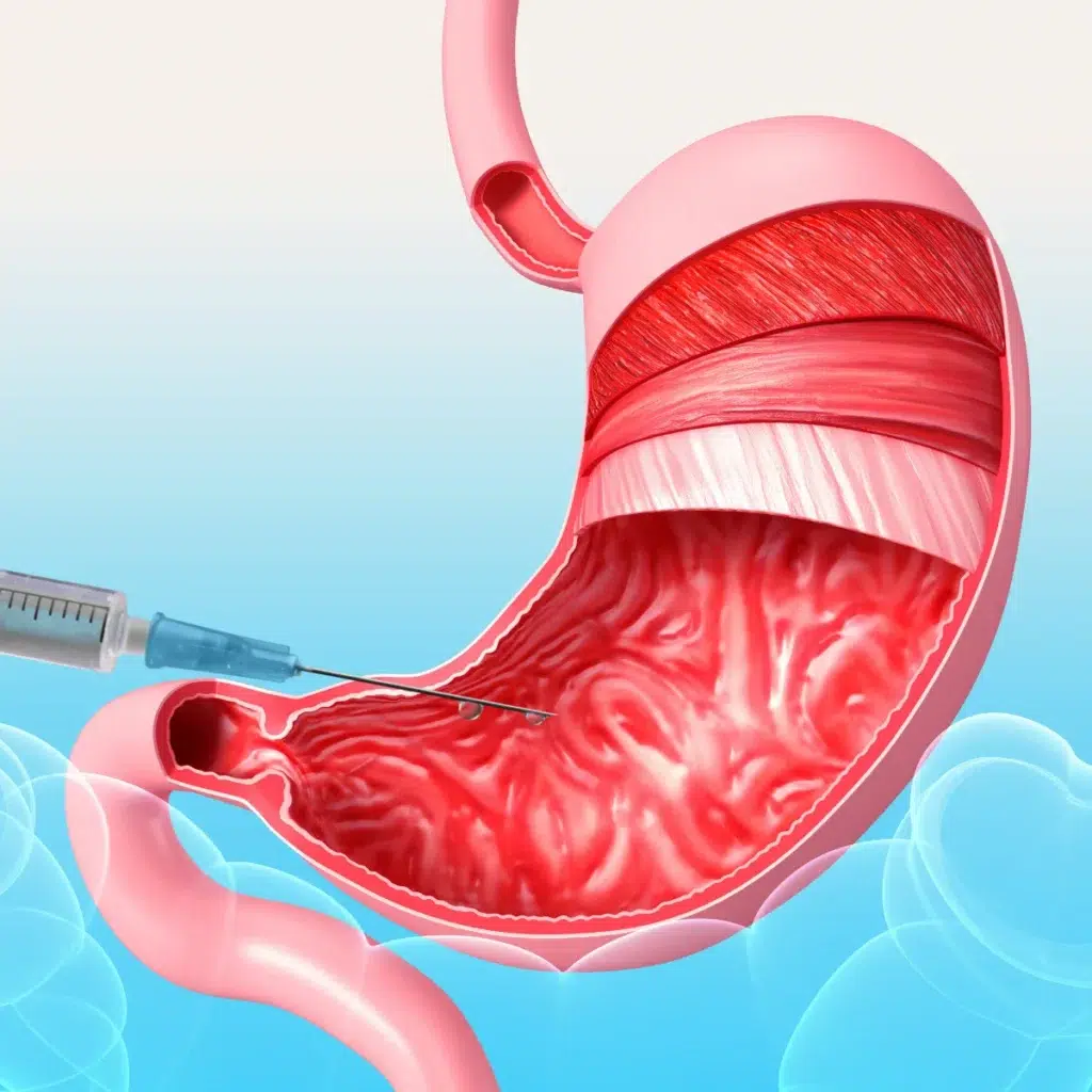 Gastric-Botox