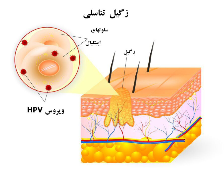 زگیل تناسلی