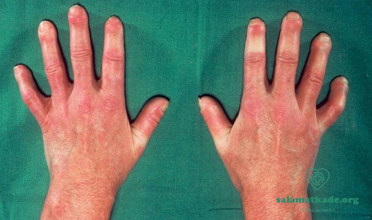 Scleroderma