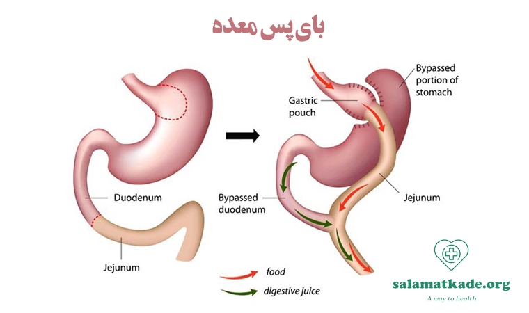 عمل بای پس معده