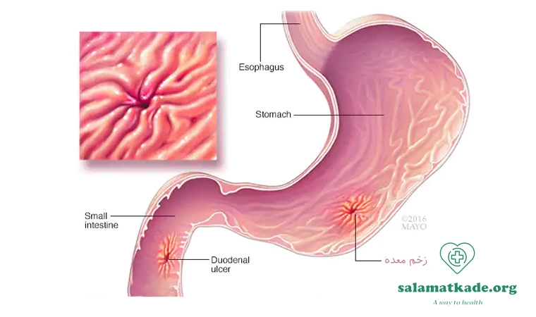 علائم زخم معده چیست