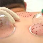 حجامت تر و خشک چیست و فواید آن چیست