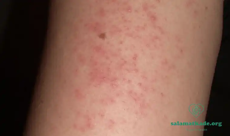 Keratosis-Pilaris