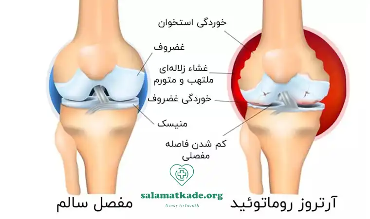 آتروز از علل خشکی مفاصل 