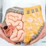 علائم عفونت روده بزرگ و درمان آن