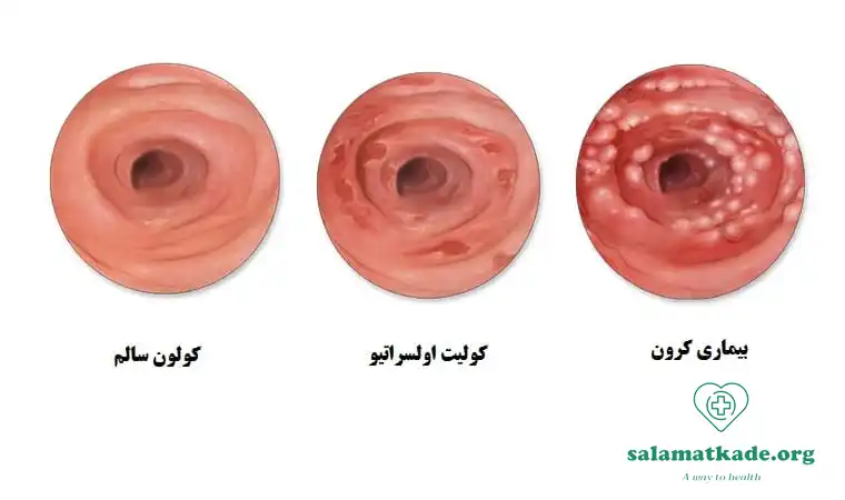 بیماری کرون روده علائم علل و درمان بیماری