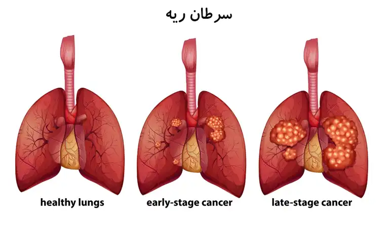 سرطان ریه