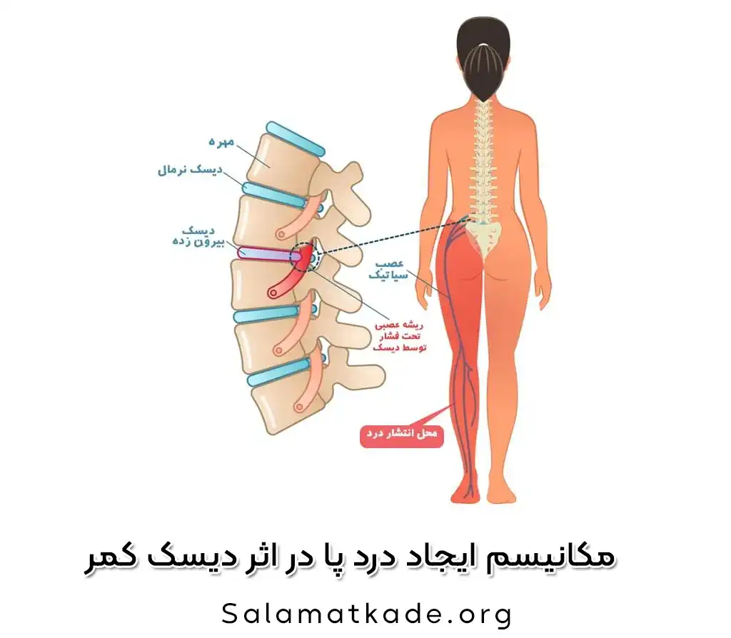 درمان دیسک کمر در طب سنتی