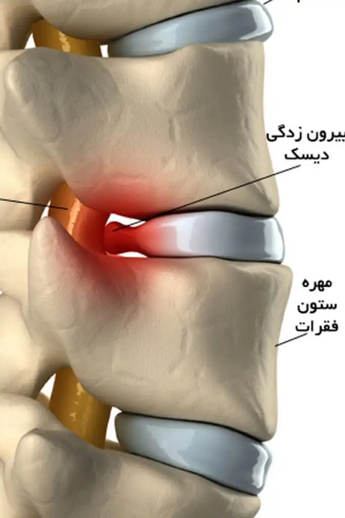درمان دیسک کمر در طب سنتی