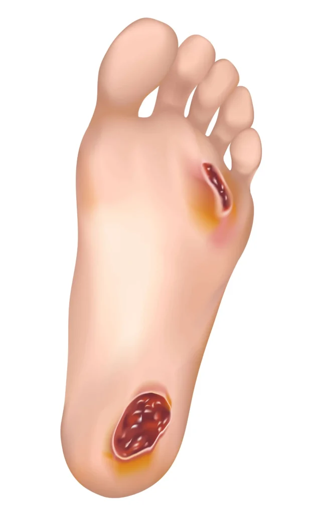 زخم پای دیابتی