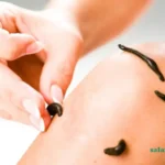 زالو درمانی و همه چیز درباره آن