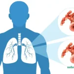 پاکسازی ریه از عفونت در طب سنتی