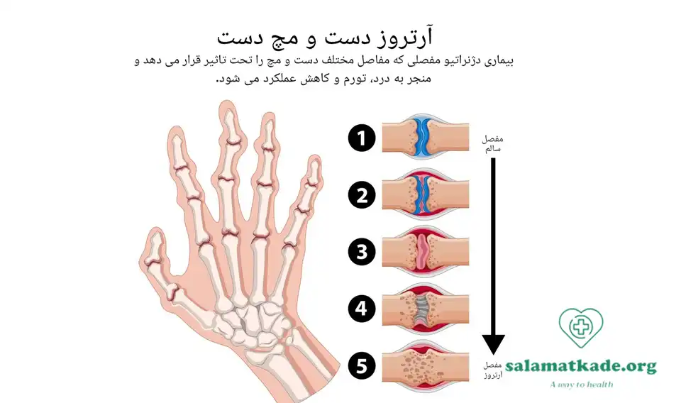 گیاهان دارویی برای روماتیسم مفصلی