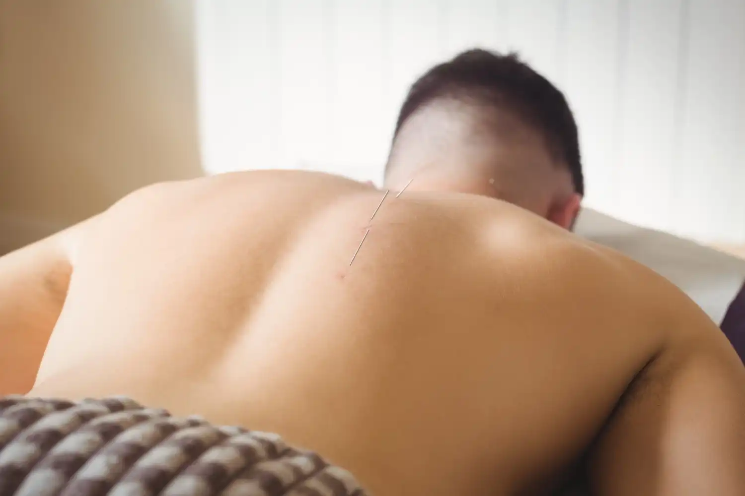 طب سوزنی برای دیسک کمر
