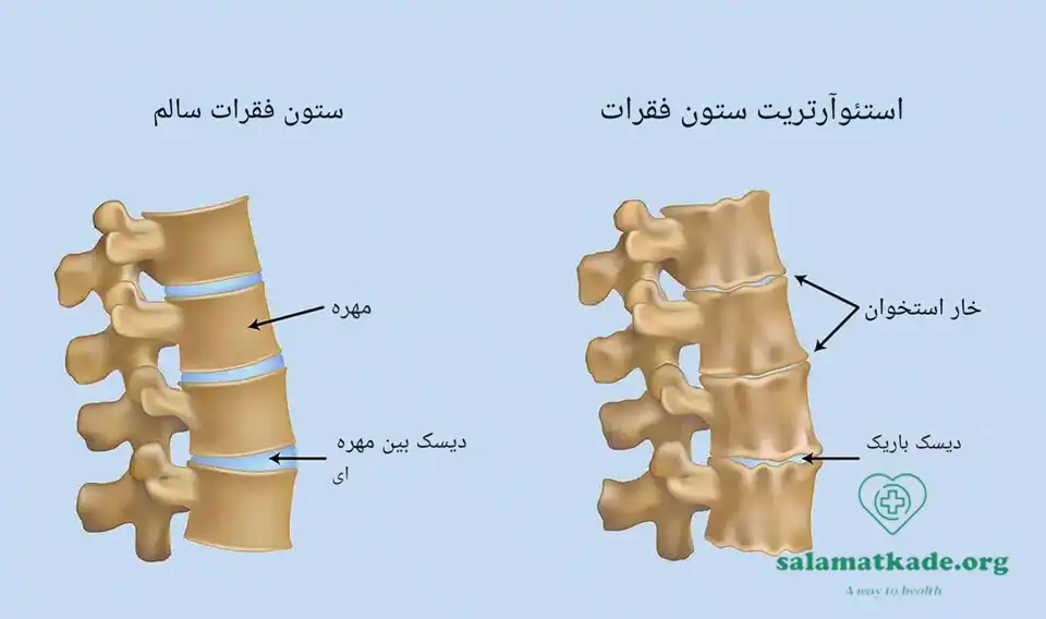 علائم آرتروز و درمان آن
