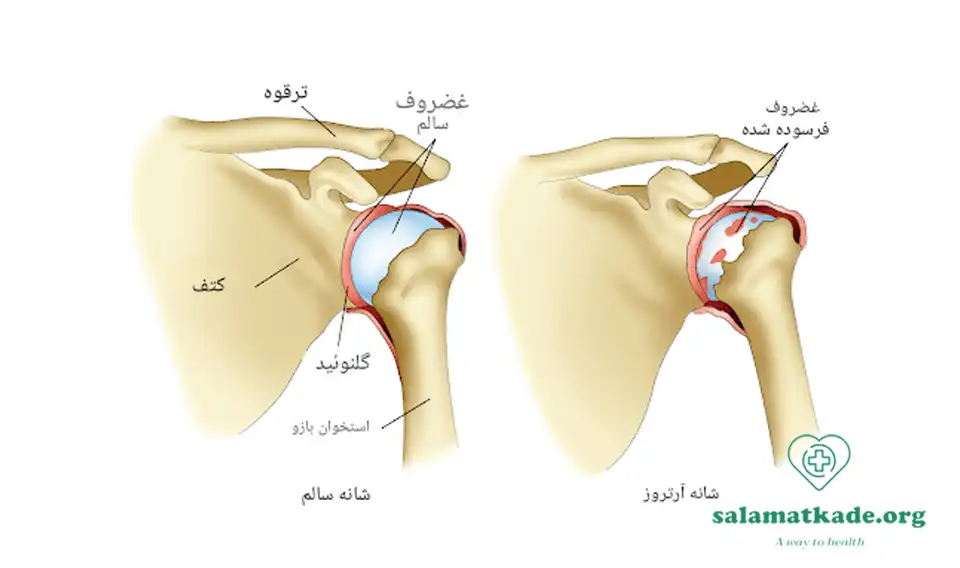 علائم آرتروز و درمان آن