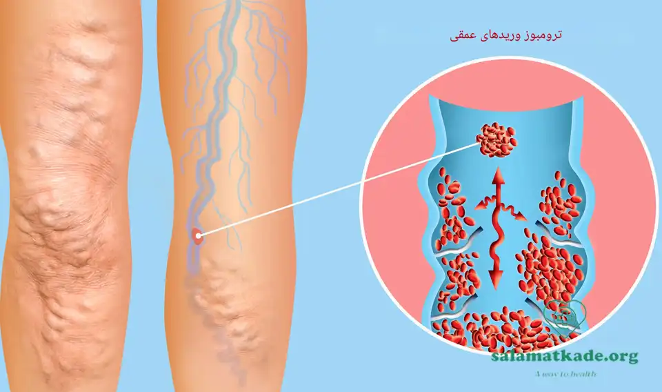 ترومبوز ورید عمقی یکی از انواع بیمارهای قلبی 