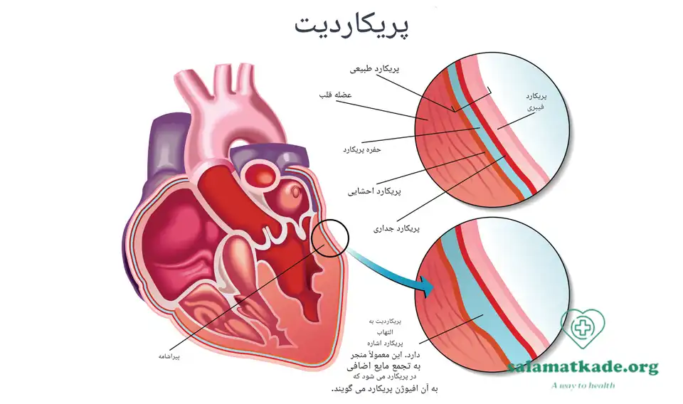 پریکاردیت یکی از انواع بیماری های قلبی 