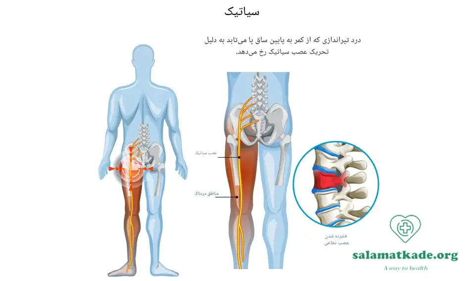 درمان سیاتیک در خانه