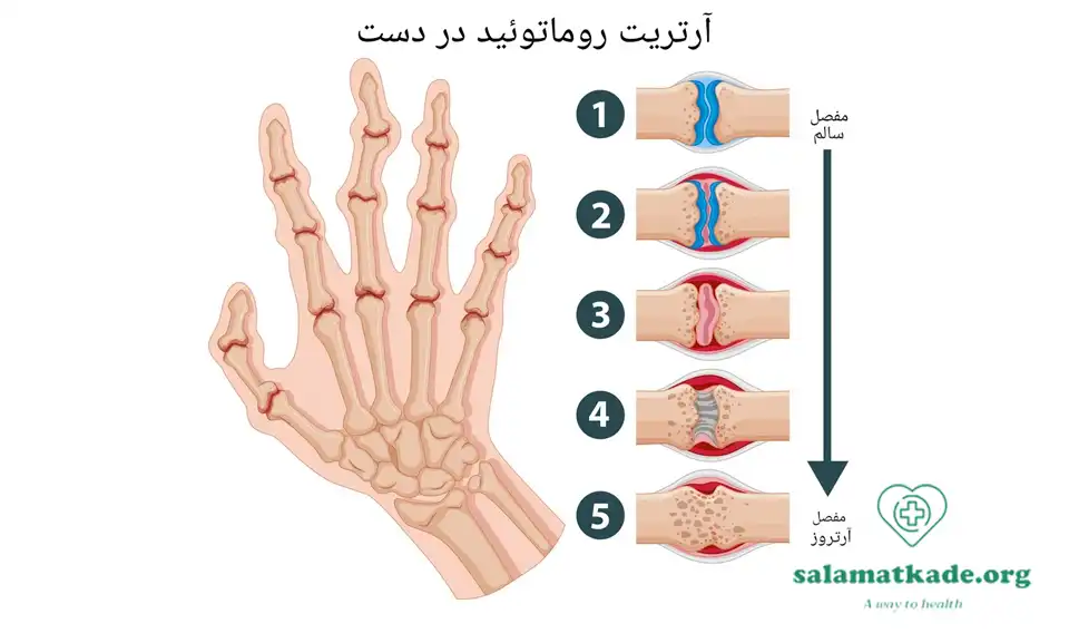 علائم آرتروز و درمان آن