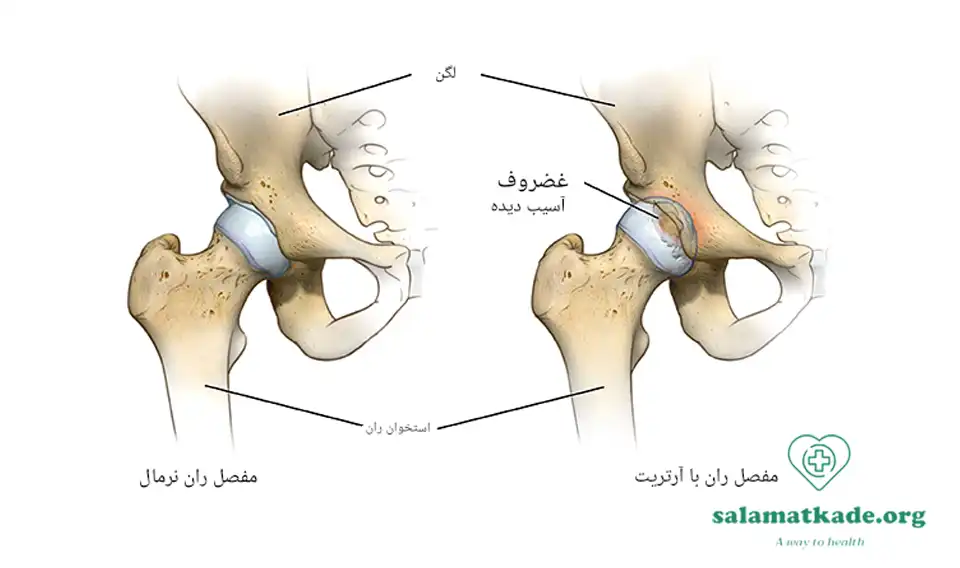علائم آرتروز و درمان آن