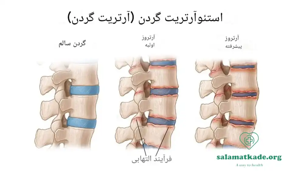 علائم آرتروز و درمان آن