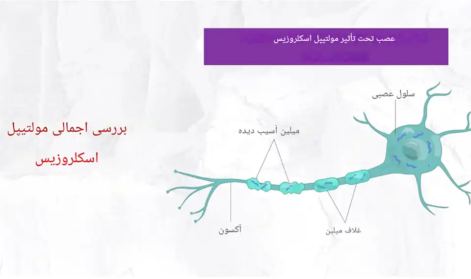 علائم ام اس و درمان آن