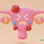 سندروم تخمدان پلی کیستیک
