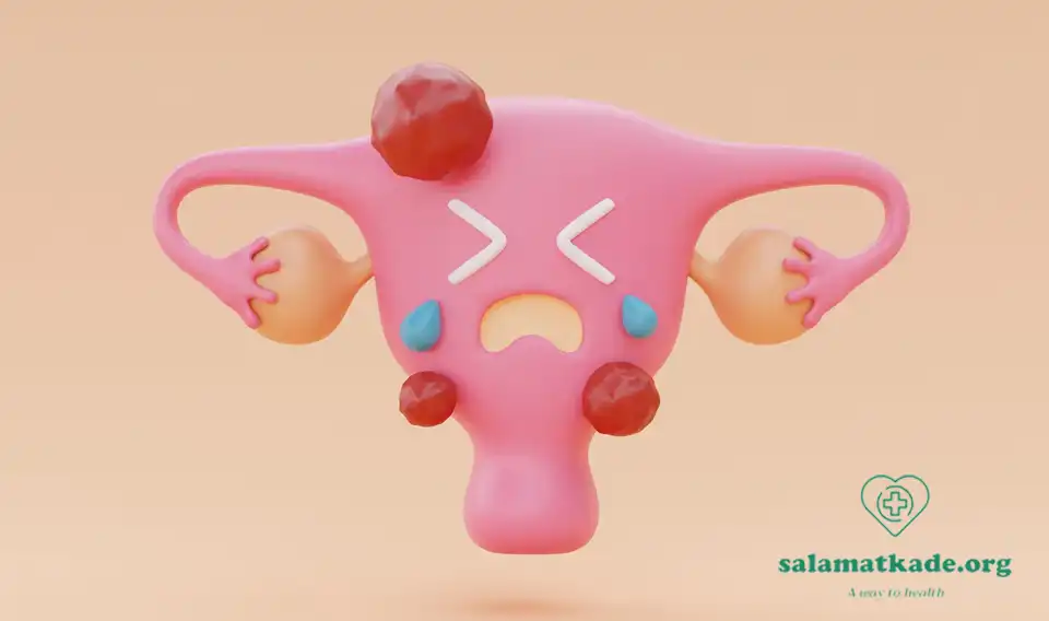 سندروم تخمدان پلی کیستیک