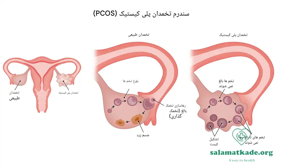 سندروم تخمدان پلی کیستیک