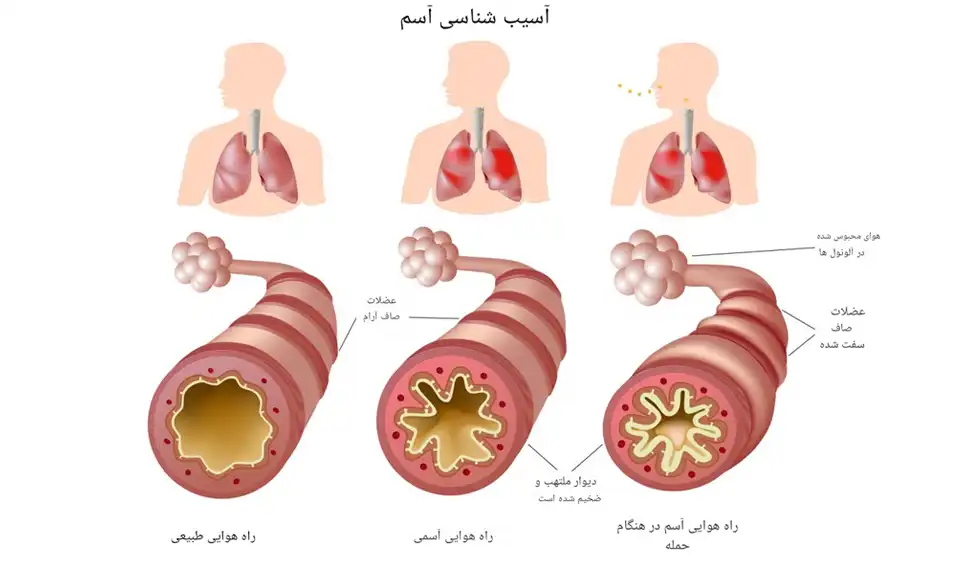 علائم آسم در بزرگسالان و کودکان
