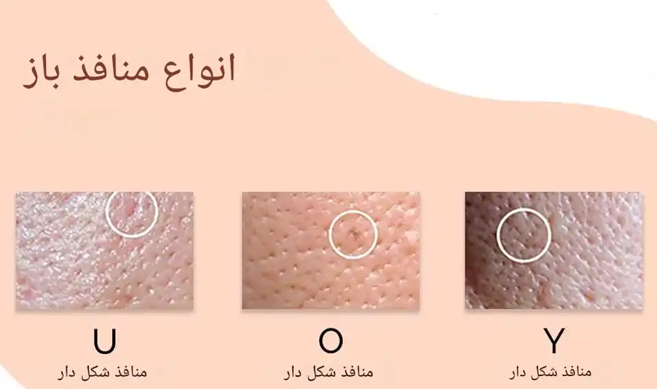 انواع منافذ باز پوست