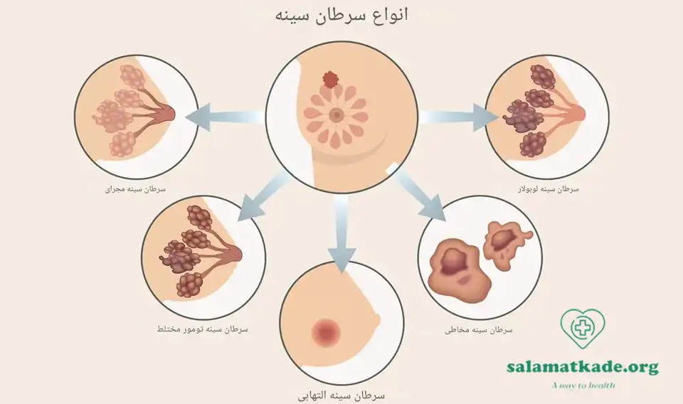پیشگیری از سرطان پستان