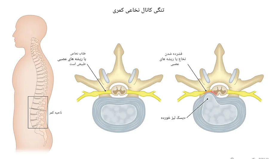 تنگی کانال نخاعی چیست و درمان آن چگونه است