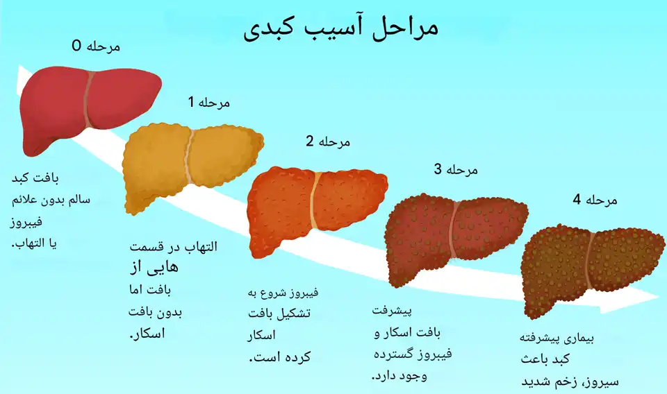 علائم سیروز کبدی و هشدارهای آن 
