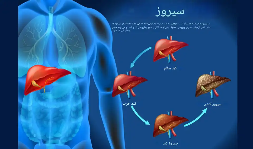 علائم سیروز کبدی و هشدارهای آن 