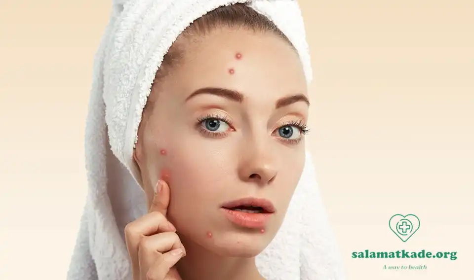 از بین بردن جوش صورت با 20 راهکار ساده