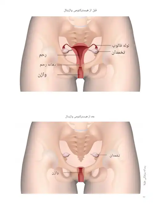 هیسترکتومی 