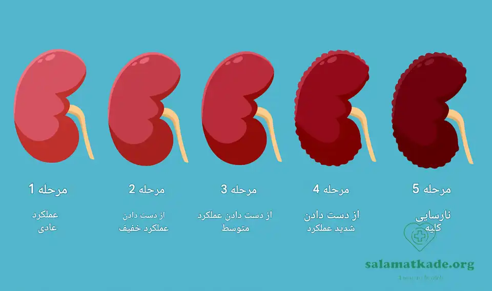 علائم نارسایی کلیه از اولیه تا پیشرفته