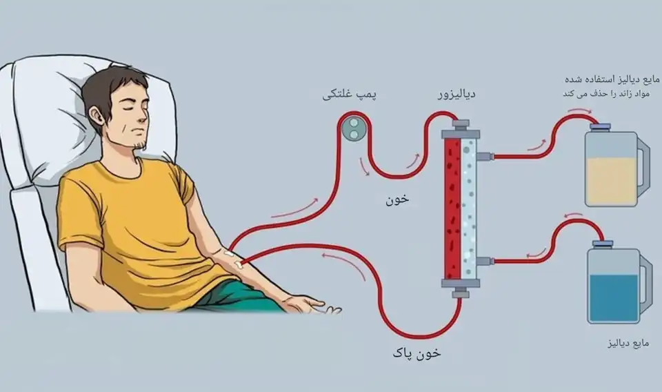 دیالیز برای نارسایی کلیه 