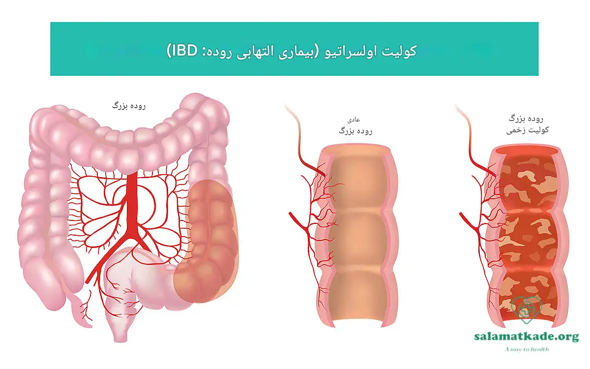 بیماری التهابی روده IBD