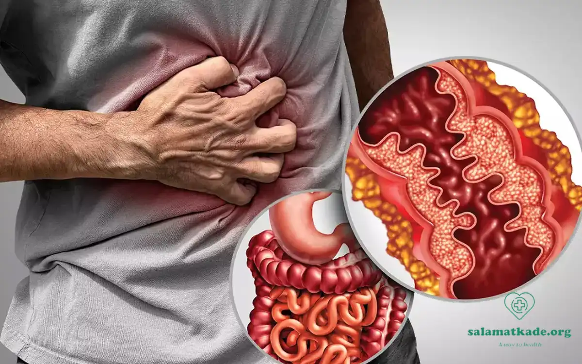 بیماری التهابی روده (IBD) چیست؟ راهنمای جامع علائم، انواع، علل و درمان
