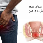 شقاق مقعدی علل و درمان