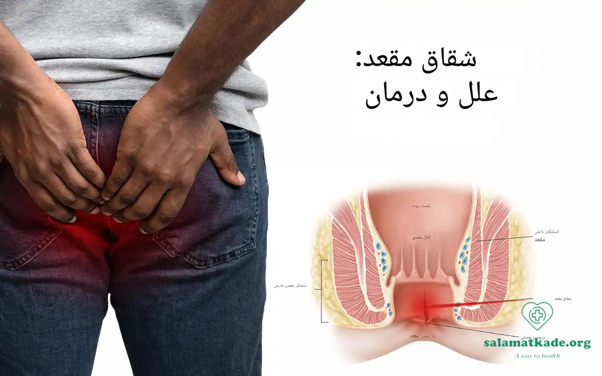 درمان شقاق مقعدی با طب سنتی 10 راهکار کاربردی
