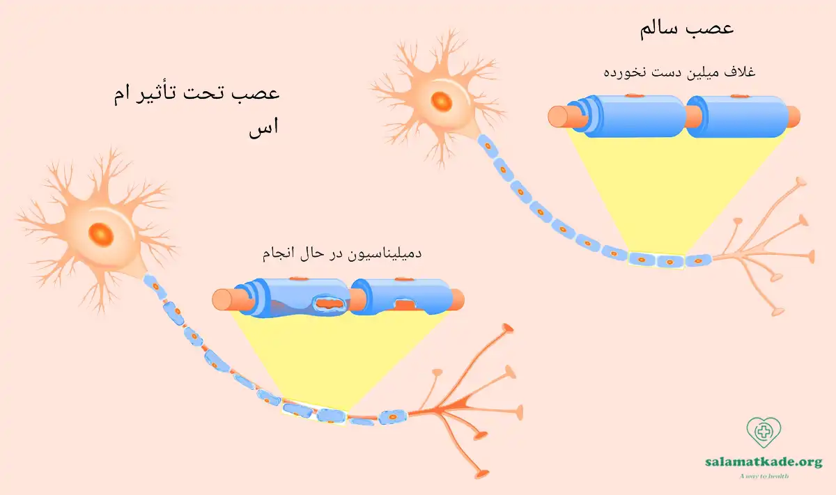 علت بیماری ام اس و علائم آن