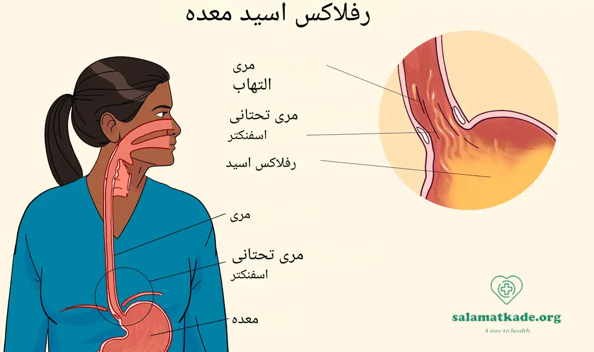 رفلاکس معده چیست و غذاهای مفید برای رفلاکس چیست