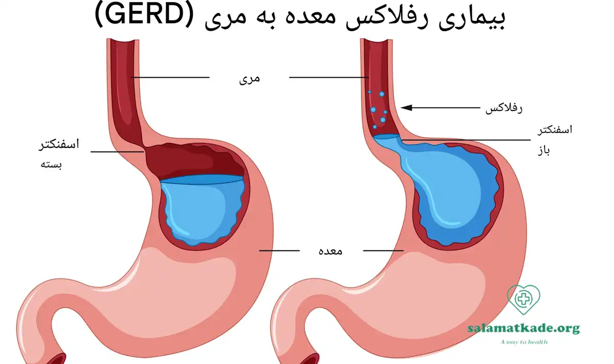 بیماری رفلاکس معده و غذاهای مفید و مضر برای رفلاکس