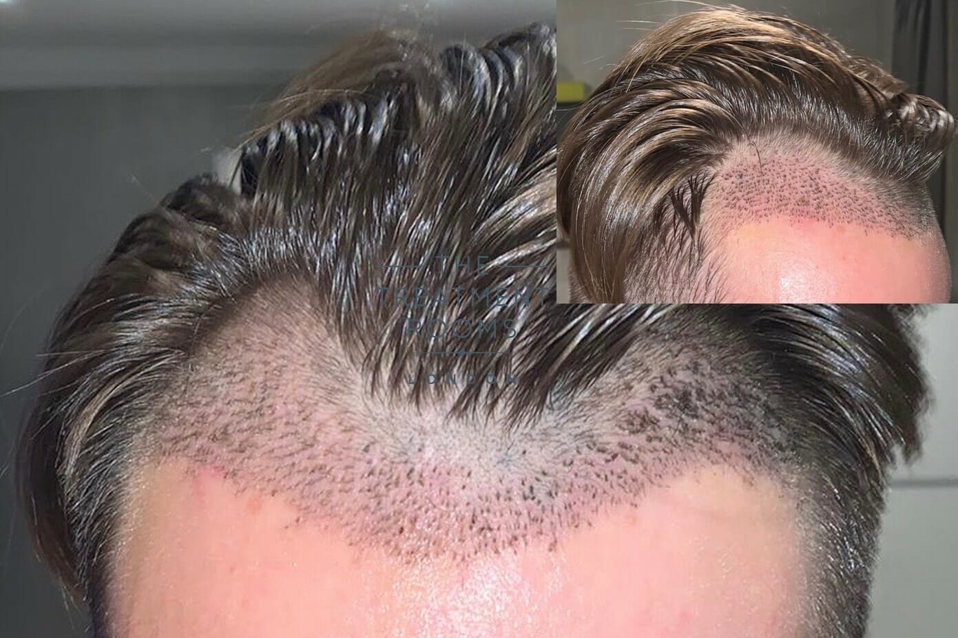 7-days-post-hair-transplant-.jpg