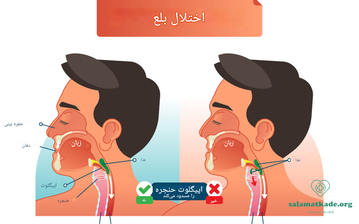 اختلال بلع