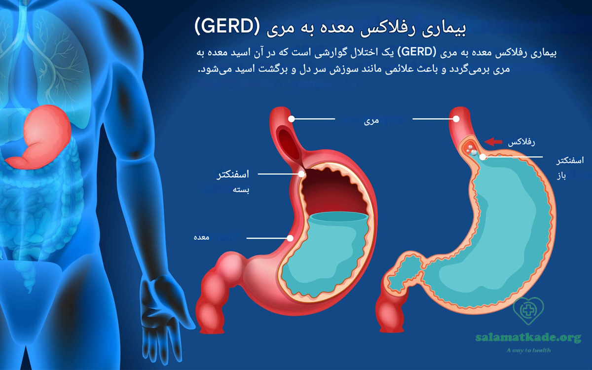 اگر رفلاکس معده درمان نشود چه می شود